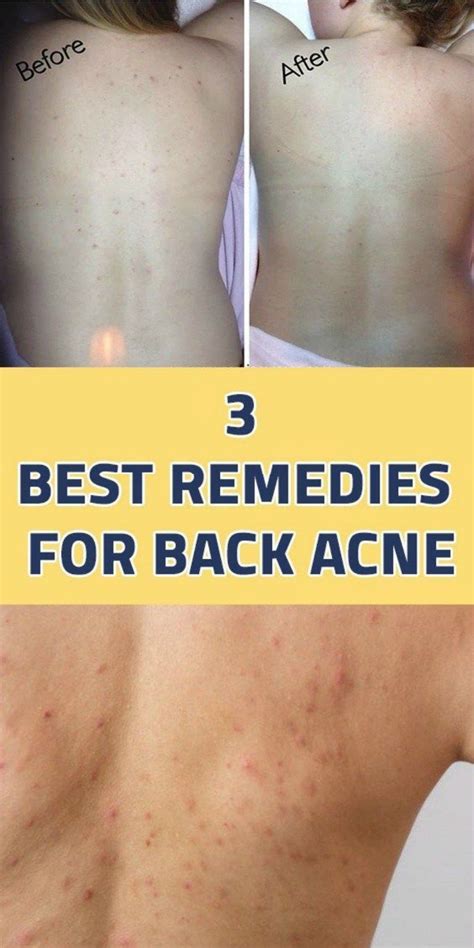 3 Best Remedies For Back Acne Back Acne Remedies Body Acne Natural