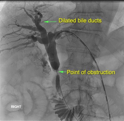 Blocked Bile Ducts Ptc Sydney Medical Interventions