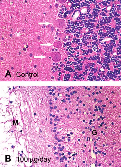 Purkinje Cell Loss In The Cerebellum Of Animals In The High Dose 100