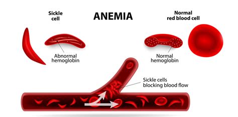 What Is Sickle Cell Anaemia And How Can Pgd Help Bridge Clinic My Xxx Hot Girl