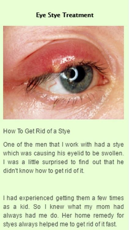 How To Get Rid Of A Stye Overnight Ph