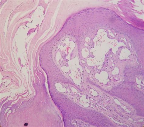 Angiokeratoma Circumscriptum Naeviforme A Case Report Of A Rare Disease