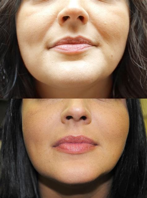 Before And After Juvederm For Nasolabial Fold Face Fillers Botox