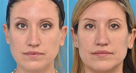 Injectable Fillers Photos Philadelphia Pa Patient 1547