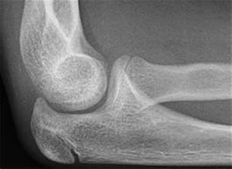 Osteochondritis Dissecans Of Elbow Shoulder And Elbow Orthobullets