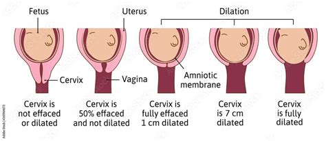 Cervical Effacement And Dilation During Labor Or Delivery Cervix
