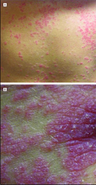 Clinical Photographs Of The Abdomen With Guttate Psoriasiform Papules