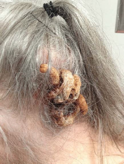 Brown, spiral, exophytic cutaneous horn on left occipital ...