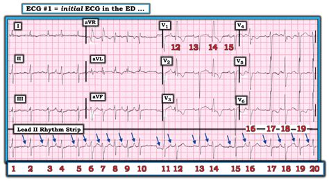 Dr Smiths Ecg Blog Atrial Fibrillation Multifocal Atrial