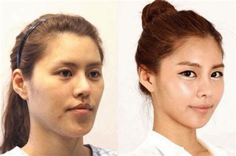 Miracles Do Exist These 52 Plastic Surgeries In Korea Are