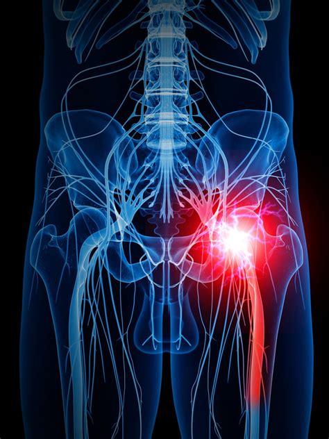 Taming The Pain Of Sciatica For Most People Time Heals And Less Is