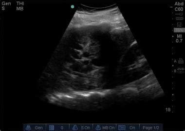 Ultrasound permitted the detection of very small amounts (even 3 to 5 ml) of loculated pleural fluid. Emergent Management of Pleural Effusion: Practice Essentials, Differentiating Exudate From ...