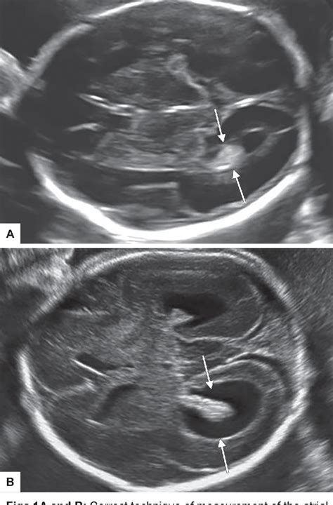 Figure 1 From Diagnosis And Counseling Of Fetal Mild Ventriculomegaly