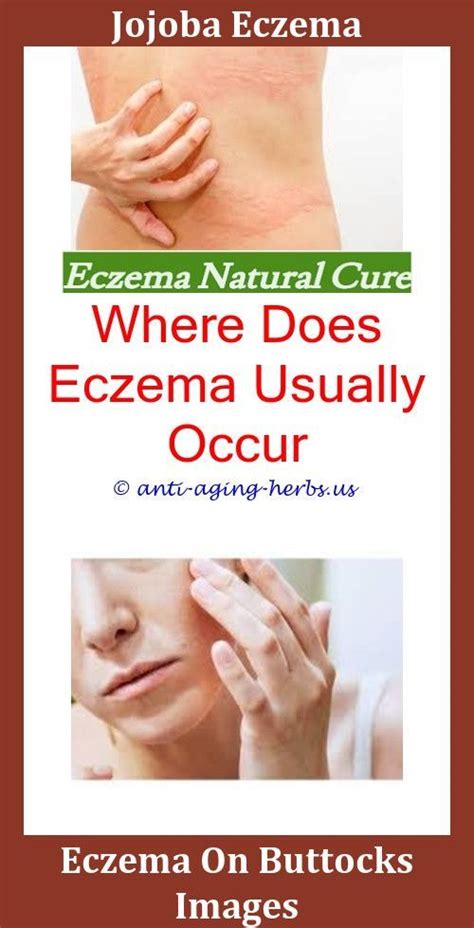 Identifying and avoiding skin irritants. Baby Eczema Treatment | Eczema psoriasis, Eczema cream ...