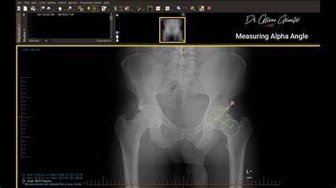 Imaging Techniques For Hip Groin Pelvic Pain By Dr Alison Grimaldi