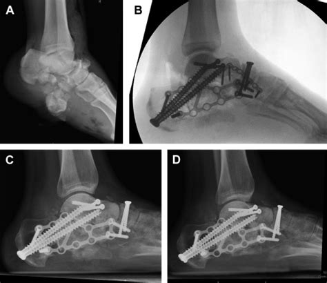 Corrective Osteotomies For Malunited Extra Articular Calcaneal