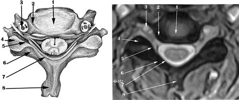 Abnormal Cervical Spine Mri