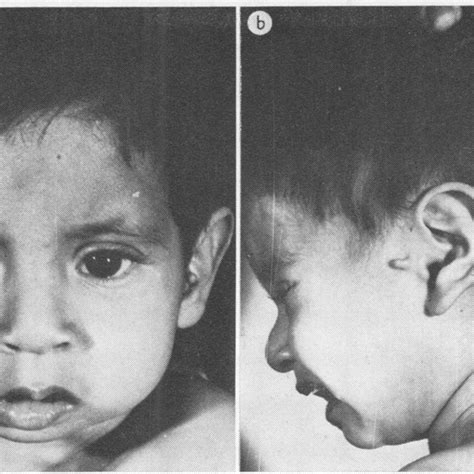 Case 1 At 4 Months Of Age Note Cranial Asymmetry Internal Strabismus