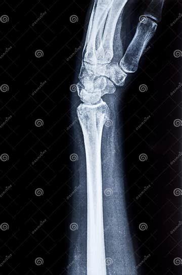 X Ray Of The Wrist And Human Radius Stock Photo Image Of Healthcare