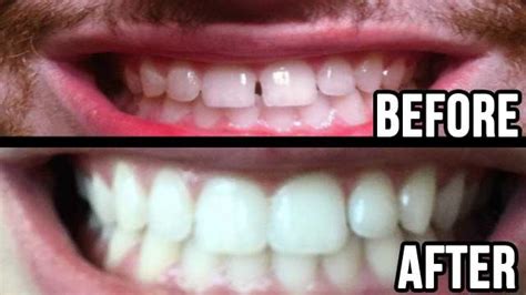 Our teeth can and do move. Can a Retainer Fix a Gap Without Braces?