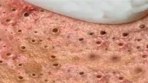 Most Satisfying Pimples And Blackheads Removal Videos 10 Youtube