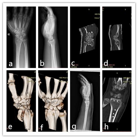 Comparison Of Radiographic And Functional Results Of Die Punch Fracture
