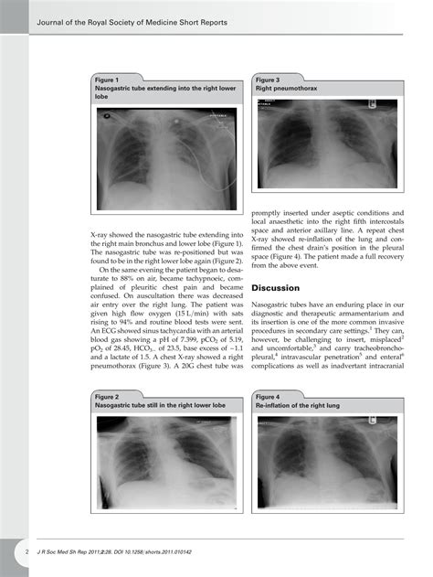 SOLUTION Pneumothorax After Nasogastric Tube Insertion Studypool