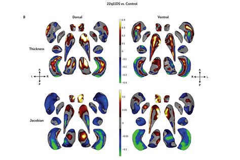 How can i help a friend or relative with schizophrenia? Remote collaborative research drives new insights on a ...