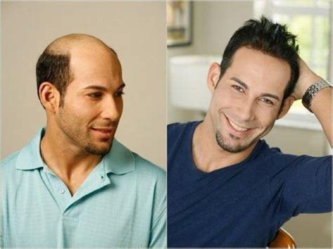 Now on the markets of beauty services, there are many types of hair extensions. GRACEFUL LIFESTYLE: (MEN) WEAVES TO GET RID OF BALDNESS