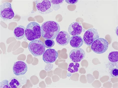 So, atypical lymphocytes morphology includes altered nuclei or/and larger cells with slightly less condensed chromatin and those with a lower n:c ratio. How I investigate monocytosis - Lynch - 2018 ...