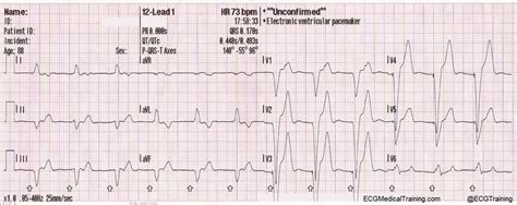 The pacemaker rhythm can easily be recognized on the ecg. The Basics of Paced Rhythms - ECG Medical Training