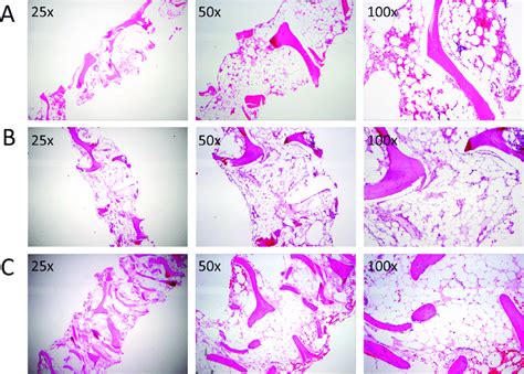 Bone Marrow Histology At The Time Of Aplastic Anemia Diagnosis In