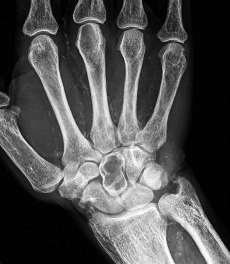 Radiografía De Mano En Proyección Anteroposterior De Un Paciente Con