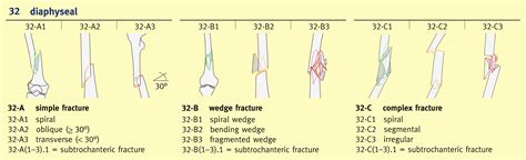 Classification Of Diaphyseal Femoral Fractures According To The Ao My