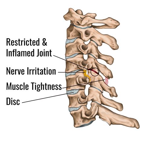 Cervical Joint Restriction Causes Neck Pain Mind And Body Chiropractic