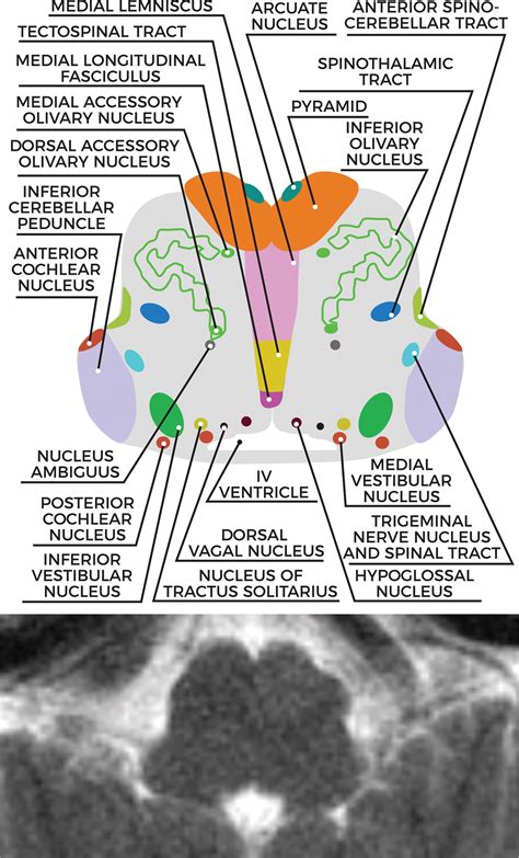 Midbrain Pons And Medulla Anatomy And Syndromes Radiographics