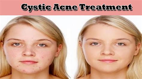 Cystic Acne Treatmentcystic Acne Treatment Home Remedy Stay Healthy