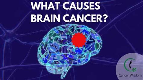 What Causes Brain Cancer Learn The Truth Now Cancer Wisdom