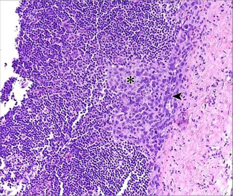 Sentinel Lymph Node Biopsy For Cutaneous Squamous Cell Carcinoma On The