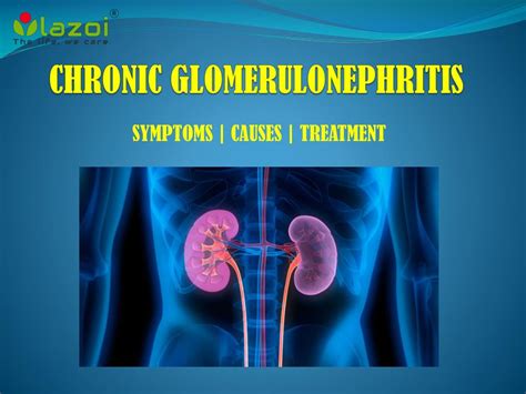 Ppt Chronic Glomerulonephritis Symptoms Causes And Treatment