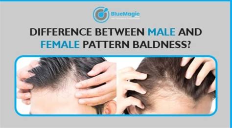 Difference Between Male And Female Pattern Baldness Blue Magic
