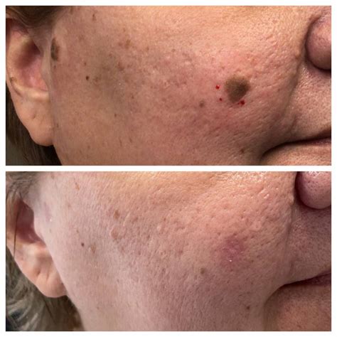 Seborrheic Keratosis Removal Before And After St Louis Dermatology Cosmetic Surgery