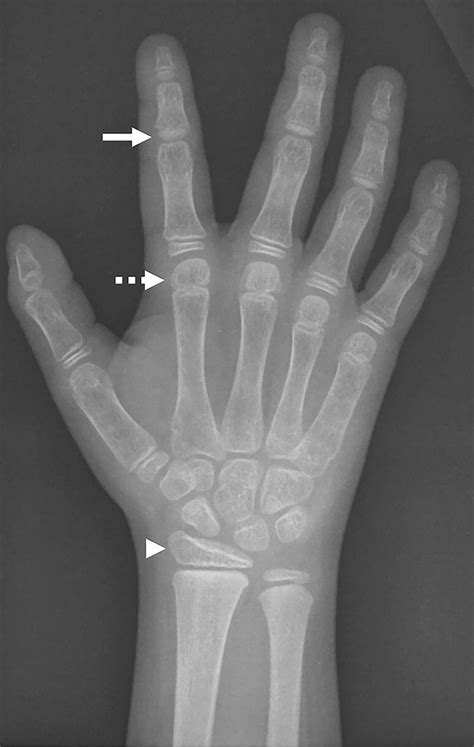 Hand Epiphyses Demonstrate Differences In Maturation On Posteroanterior
