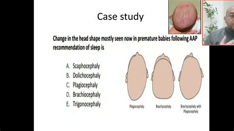 Case 59 Aap Recommendations Of Sleep In Premature Babies Abnormal Head