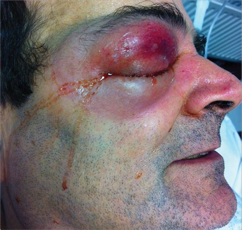 If you do, intravenous (iv) antibiotics during labor can save your baby's life. Periorbital Necrotizing Fasciitis Following Dexamethasone ...