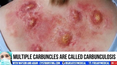 Furuncles Carbuncles Symptoms Causes Treatment Tibot