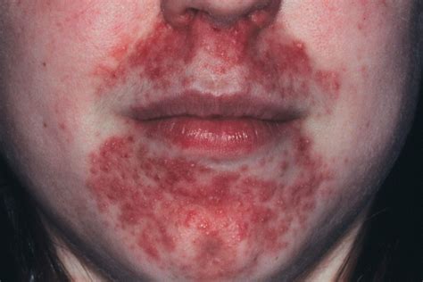 Perioral Dermatitis Heres How To Treat It The Healthy