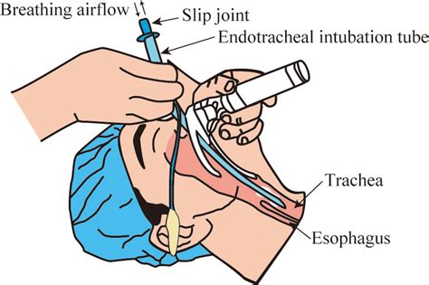 Endotracheal Intubation Tube Inserted In Airway 1 Download