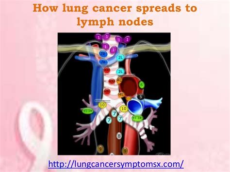 How Lung Cancer Spreads To Lymph Nodes
