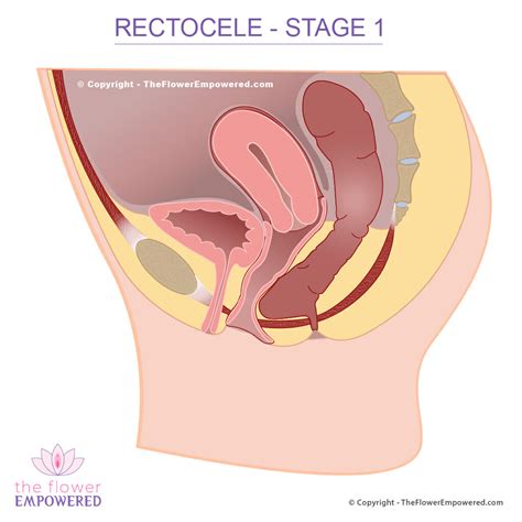 Rectocele Prolapsed Rectum Pelvic Organ Prolapse Stage To